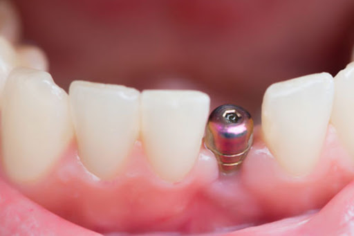 mini dental implant