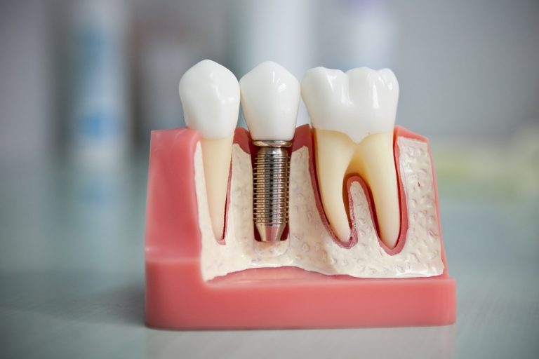 Düşen diş implantı tekrar yerine takılır mı?