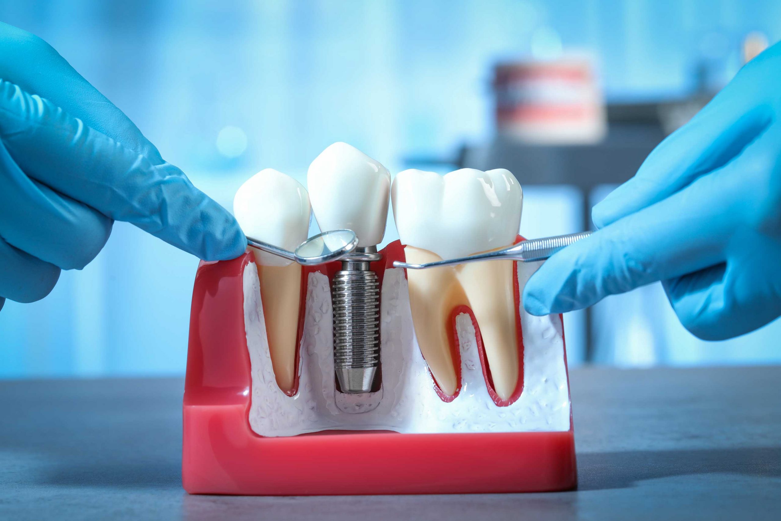 Diş İmplantları Zararlı Mıdır?