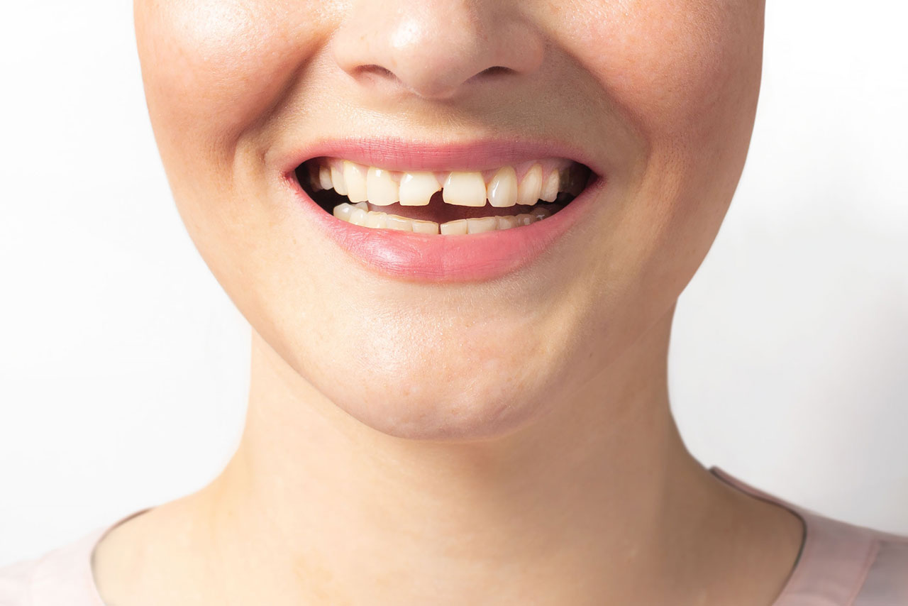 Diş Kırılması Tedavi Edilebilir Mi?