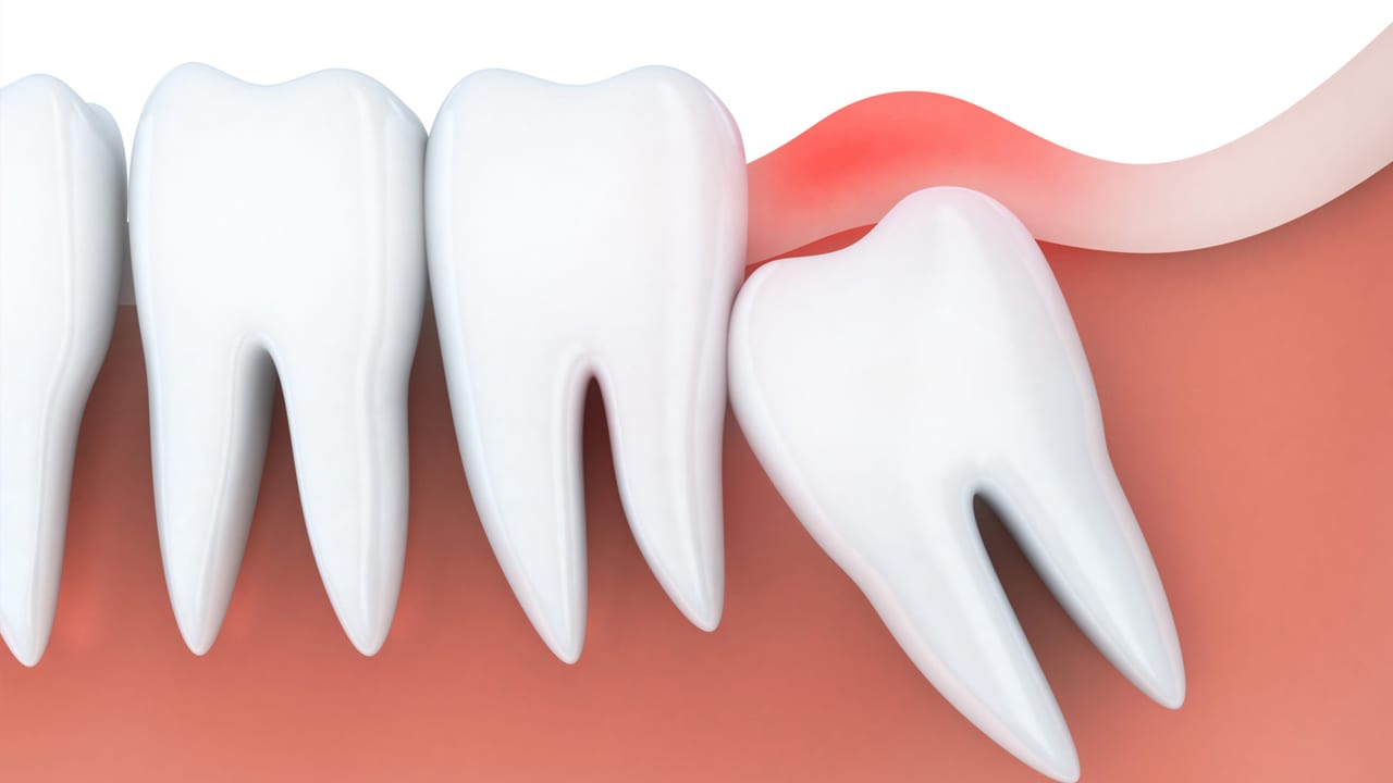 Gömülü 20’lik Diş Çekimi Ağrılı Bir Tedavi Mi?